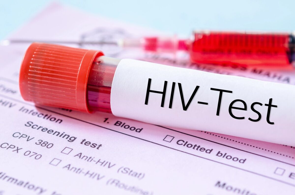 آزمایش HIV